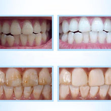 Charger l&#39;image dans la galerie, Kit blanchiment dentaire, l’offre idéale pour des dents blanchies